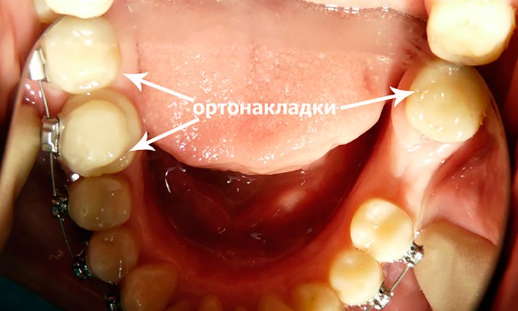 прикус исправляемый