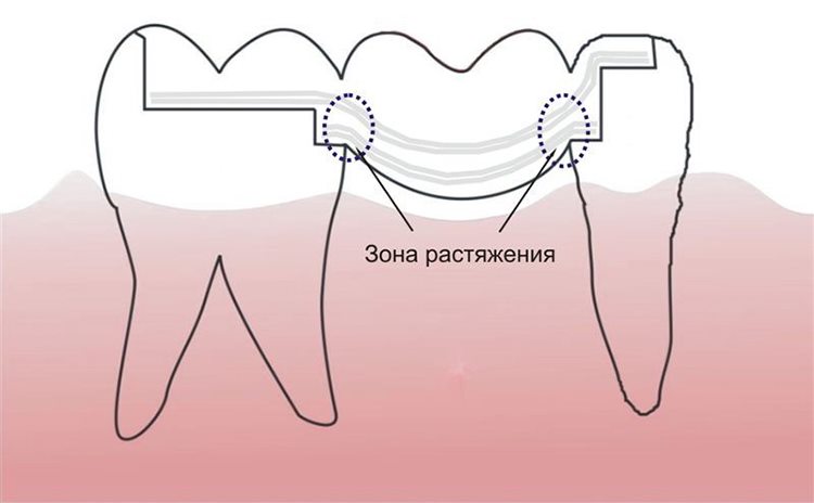 протез по методике Ервандяна