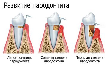 развитие патологии