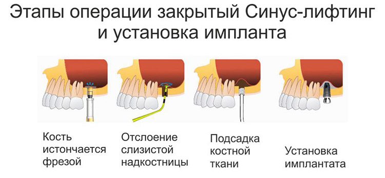 как проводится лифтинг